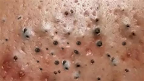 blackhead in ear removal videos|2023 newest pimple popping videos.